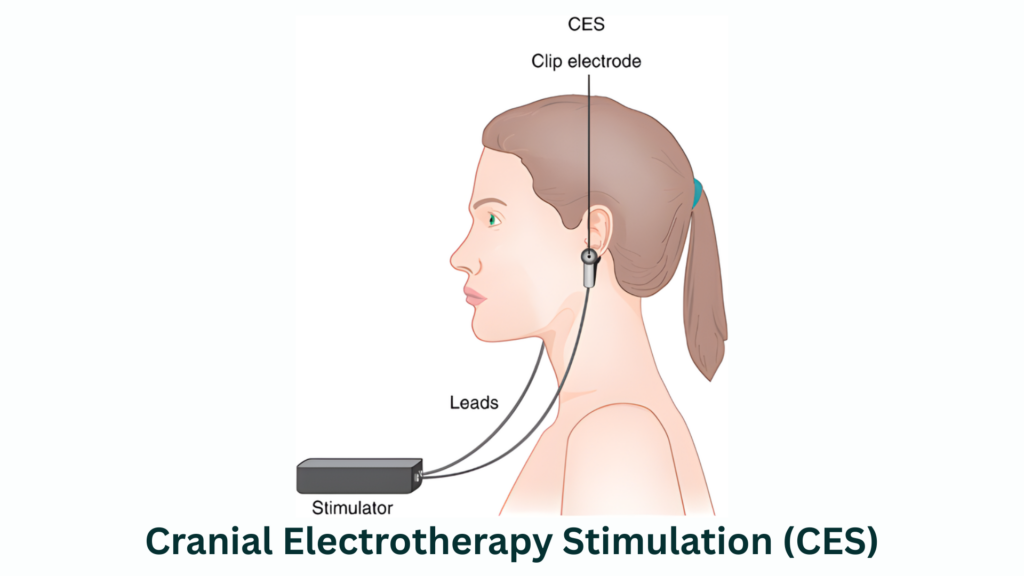 אלקטרותרפיה באמצעות גירוי גולגולתי