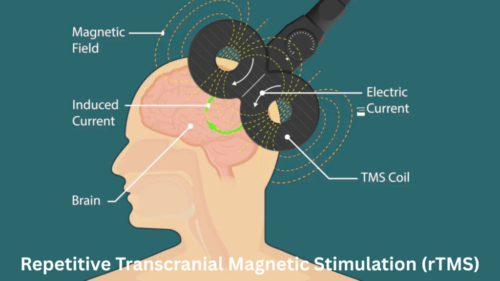 גירוי מגנטי מוחי חוזר