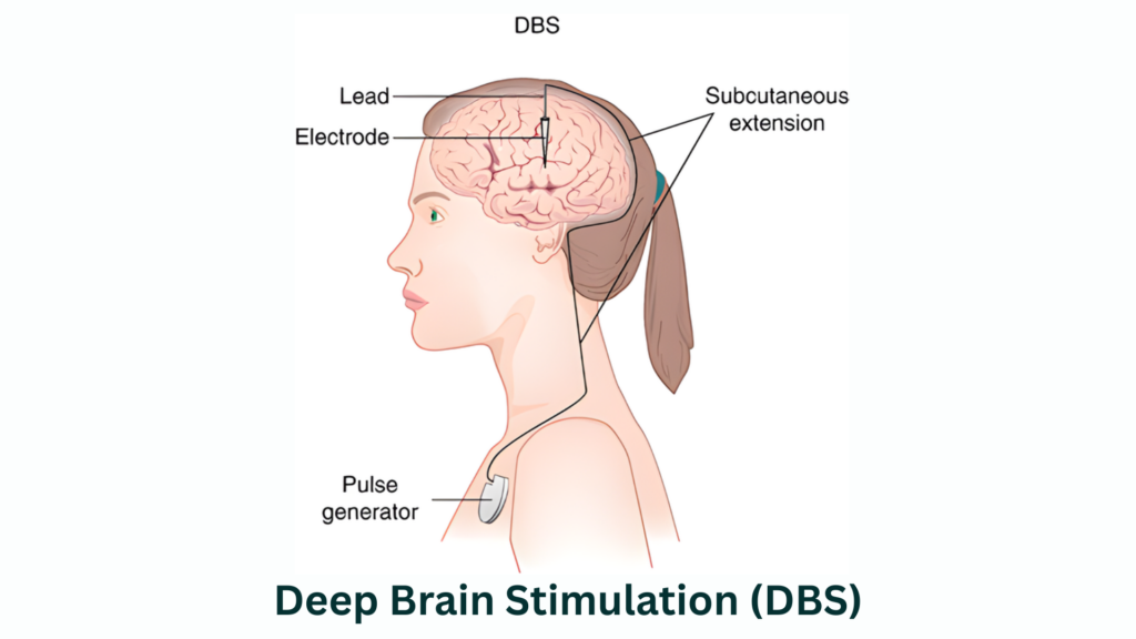 גירוי מוחי עמוק (2)