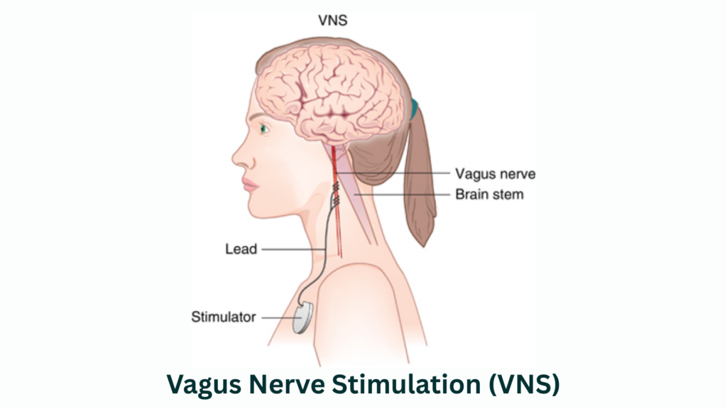 גירוי עצב הואגוס